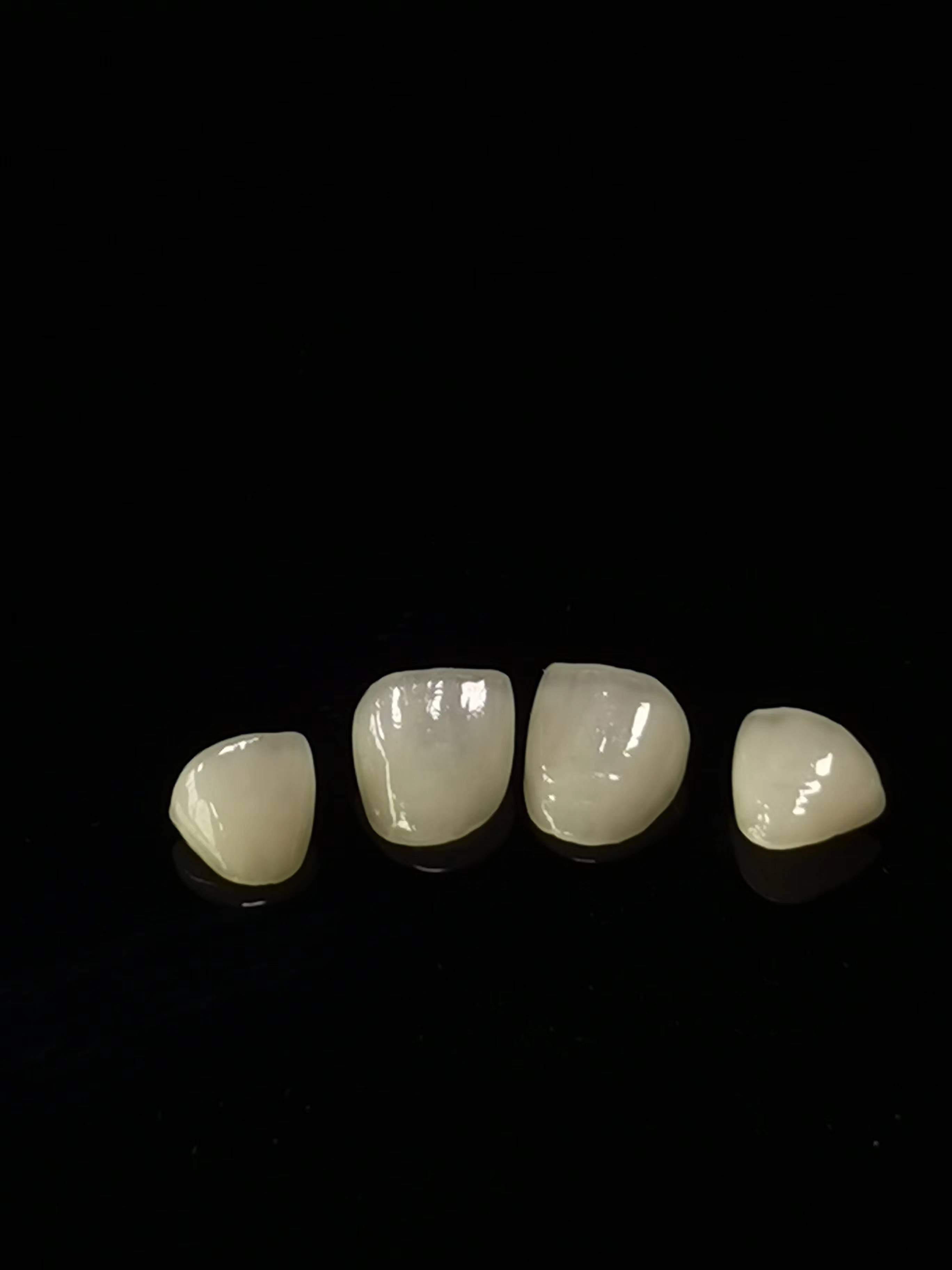 E.max Dental lab Arbete