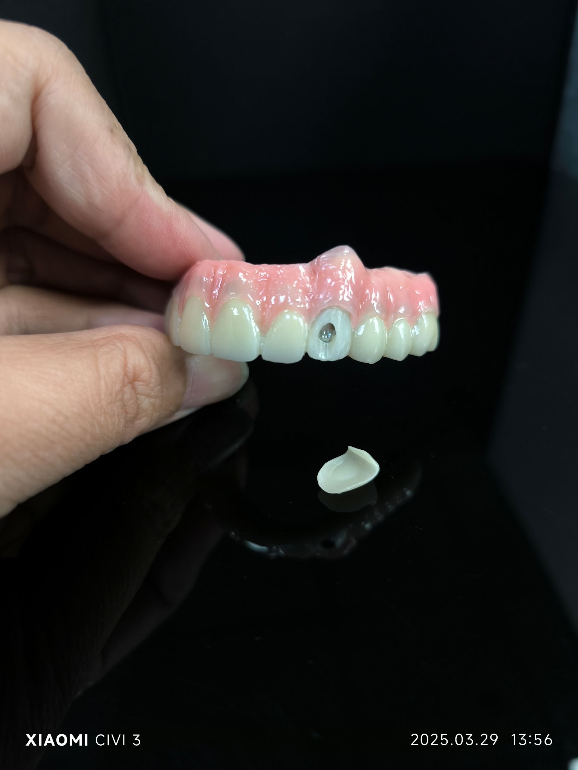 Allt på 4 - Hybrid Zirconia Bridge -lösning för vestibular skruvhål