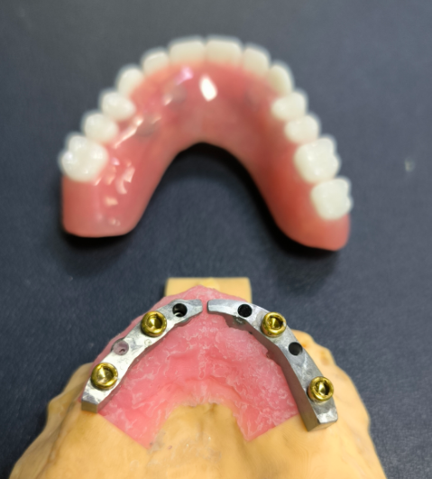 Locator och Titanium Dental Bar