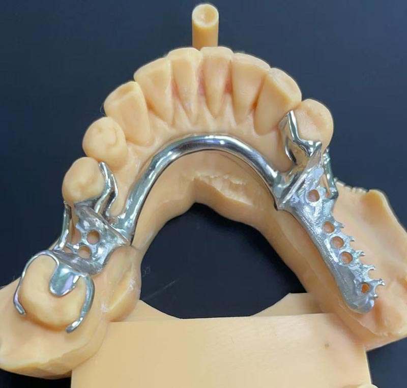 Fördelar med Cobalt-Chromium Framework (Co Cr Framework)