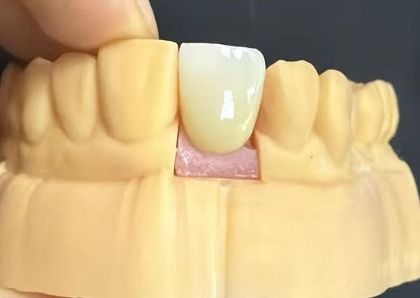 Glappar mellan tänderna kan fixas – raka tänder är det mest attraktiva!