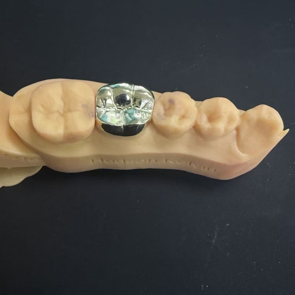 Guldkronor: ädelmetallvalet för livslång tandrestaurering