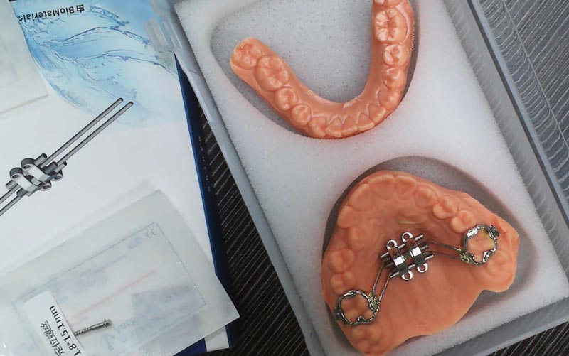 Förstå MSE Skeletal Expansion med WM Dental Lab