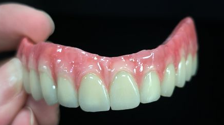 Alla på 4 hybrid - Malo Bridge Full Zirconia Crowns över titanstruktur