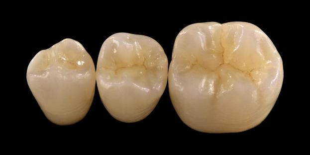 <h2>Zirconia i tandvården: Indikationer, fördelar och kliniska överväganden</h2>
<p>Zirconia är allmänt känt för sin styrka och hållbarhet. De senaste generationerna av zirkoniummaterial erbjuder också avsevärt förbättrade estetiska egenskaper. För patienter som överväger helkeramiska restaureringar är det viktigt att noggrant utvärdera både indikationerna och begränsningarna för zirkoniumbaserade system.</p>
<p>Dagens patienter förväntar sig alltmer restaureringar som kombinerar utmärkt estetik med full funktionell prestanda. De flesta moderna keramiska system kan uppfylla dessa förväntningar, men klinisk framgång beror till stor del på korrekt materialval, tandförberedelse och cementeringsprotokoll. Valet bör styras av viktiga materialegenskaper som brotthållfasthet, böjhållfasthet, slitstyrka och långtidsstabilitet. Bland dessa material har zirkoniumoxid blivit ett av de mest använda alternativen inom samtida restaurerande tandvård.</p>
<h3>Varför välja Zirconia?</h3>
<p>Zirconia värderas för sin exceptionella styrka och långvariga hållbarhet. Moderna zirkoner skiljer sig markant från tidigare generationer, som var mer ogenomskinliga och mindre estetiska. Idag möjliggör CAD/CAM-teknik exakt tillverkning av zirkoniumoxidrestaurationer med förbättrade optiska egenskaper.</p>
<p>Restaureringar kan utformas som:</p>
<ul>
<li><strong>Monolitiska zirkoner:</strong>Idealisk för bakre kronor och broar, erbjuder hög styrka och hållbarhet.</li>
<li><strong>Lagerad zirkon:</strong>Lämplig för fall som kräver förbättrad estetik, inklusive långvariga restaureringar över olika delar av munnen.</li>
</ul>
<p>Böjhållfastheten varierar beroende på typ, från cirka 590 MPa i högtranslucens zirkoniumoxid till upp till 1400 MPa i monolitiska former. Zirkoniumoxidrestaurationer kan cementeras med självhäftande hartscement eller hartsmodifierade glasionomercement.</p>
<h3>Nyckelfaktorer vid val av Zirconia material</h3>
<p>När man överväger zirkoniumoxid för en helkeramisk restaurering, bör läkare utvärdera flera kritiska faktorer:</p>
<ul>
<li>Kvarvarande tandstruktur</li>
<li>Placering i munhålan (estetisk zon vs funktionell zon)</li>
<li>Förekomst av parafunktionella vanor som bruxism</li>
<li>Genomskinlighet av intilliggande naturliga tänder</li>
<li>Färg och skick på underliggande tandstruktur</li>
</ul>
<p>Den estetiska zonen inkluderar vanligtvis de främre tänderna, även om den hos vissa patienter kan sträcka sig till den första molaren beroende på leende och ansiktsdynamik. Den funktionella zonen innefattar i allmänhet premolarer och molarer, där ocklusala krafter är betydligt högre.</p>
<h3>Funktionella zonapplikationer</h3>
<p>I bakre regioner måste ocklusala krafter noggrant övervägas. Zirconia är ett utmärkt alternativ till traditionella PFM-restaureringar, speciellt i fall med begränsat restaureringsutrymme. Moderna monolitiska zirkoner tillåter fullkonturdesign av ocklusal anatomi, inklusive funktionella cusps och marginella åsar, samtidigt som hög hållfasthet bibehålls.</p>
<p>Aktuella bevis visar att monolitisk zirkoniumoxid är väl lämpad för bakre kronor och broar med flera enheter på grund av dess utmärkta motståndskraft mot brott och slitage. Framsteg inom vidhäftningsteknik och preparatdesign har också förbättrat långsiktiga kliniska resultat.</p>
<h3>Applikationer för estetiska zoner</h3>
<p>I den främre regionen måste restaureringar nära replikera naturlig tandfärg, genomskinlighet och ljusbeteende. Även om material som litiumdisilikat erbjuder utmärkt estetik, är de mindre starka och kräver vanligtvis limning.</p>
<p>En viktig fördel med zirkoniumoxid är dess förmåga att cementeras på konventionellt sätt samtidigt som den uppnår hög estetisk prestanda. Med utvecklingen av höggenomskinliga och flerskiktiga zirkoniumoxidsystem är det nu möjligt att producera restaurationer som nära efterliknar naturlig tandsättning.</p>
<p>Avancerade bearbetningstekniker förbättrar de optiska egenskaperna ytterligare och minskar brister som kan påverka ljustransmission och utseende.</p>
<h3>Styrka och estetik kombinerat</h3>
<p>Tidiga zirkoniumoxidsystem prioriterade styrka men saknade estetisk kvalitet. Modern monolitisk zirkoniumoxid kombinerar framgångsrikt både styrka och förbättrat utseende, vilket gör den lämplig för ett brett spektrum av kliniska fall.</p>
<p>Det är särskilt fördelaktigt för patienter med parafunktionella vanor eller tidigare restaureringsfel. Kliniska studier indikerar hög patientacceptans och låga komplikationsfrekvenser.</p>
<p>Oron för slitage på motsatt tand har minskat med nyare formuleringar. Högpolerade zirkoniumoxidytor uppvisar låg nötningspotential och kan i vissa fall vara skonsammare än traditionella restaureringar av porslin som smälts till metall.</p>
<h3>Zirconia implantat: framväxande alternativ</h3>
<p>Medan titanimplantat förblir den kliniska standarden, vinner zirkoniumimplantat uppmärksamhet som ett metallfritt alternativ. Tidiga konstruktioner var i första hand system i ett stycke, men tvådelade zirkoniumoxidimplantat möjliggör nu förbättrad protesflexibilitet.</p>
<p>Zirkoniumimplantat är särskilt användbara i fall där estetiska problem finns, såsom potentiell grå missfärgning av peri-implantatvävnader eller tunn gingival biotyp. De kan också övervägas för patienter med sällsynt titankänslighet.</p>
<p>Emellertid är zirkoniumoxidimplantat fortfarande relativt nytt och kliniska data på lång sikt är fortfarande begränsade jämfört med titansystem.</p>
<h3>Slutsats</h3>
<p>Zirconia har utvecklats till ett mycket mångsidigt material inom restaurerande tandvård, som erbjuder en stark balans mellan mekanisk prestanda och estetik. Korrekt val av fall och efterlevnad av kliniska protokoll är avgörande för att uppnå optimala resultat i både främre och bakre applikationer.</p>