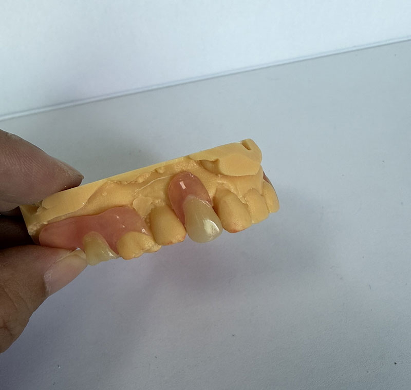 Valplast partial restoration from WM Dental Lab